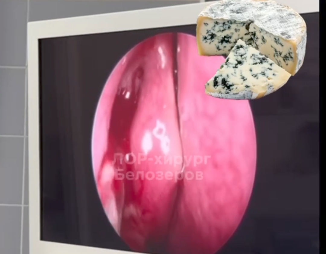 В Нижнем Новгороде прооперировали сыровара с грибком в&nbsp;носу