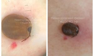 Клеща обнаружили у нижегородки на плановом осмотре родинок