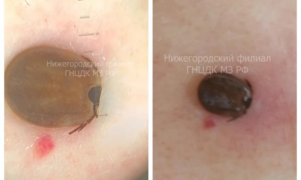 Клеща обнаружили у нижегородки на плановом осмотре родинок