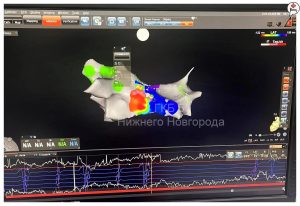 Инновационную 3D-систему успешно использовали для лечения аритмии у нижегородца